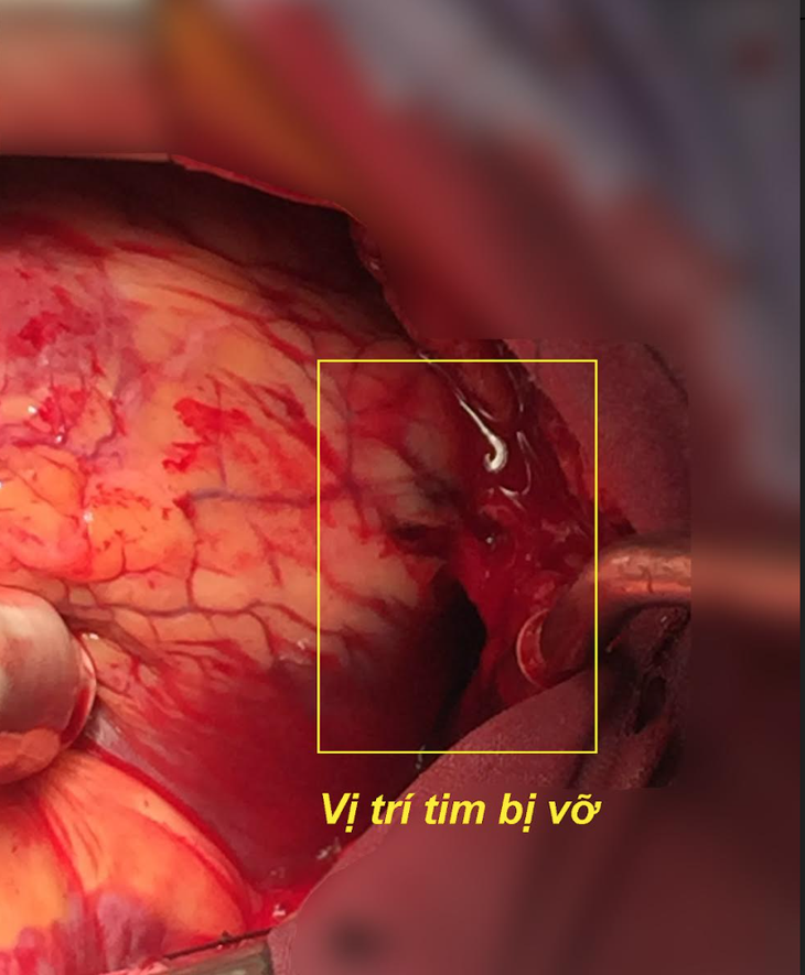 Cứu sống bệnh nhân vỡ và ngưng tim sau nhồi máu cơ tim - Ảnh 1.