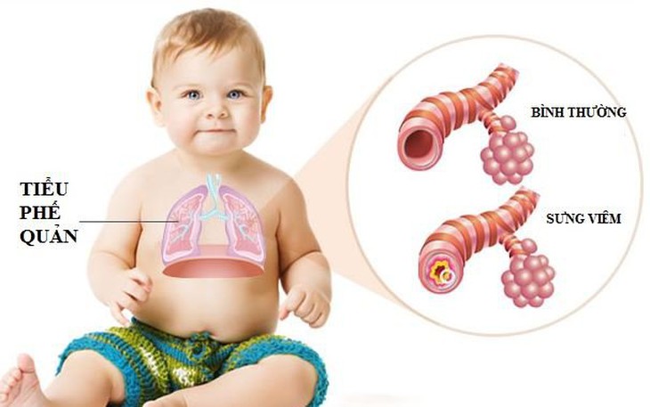 Viêm tiểu phế quản cấp ở trẻ khi thời tiết giao mùa