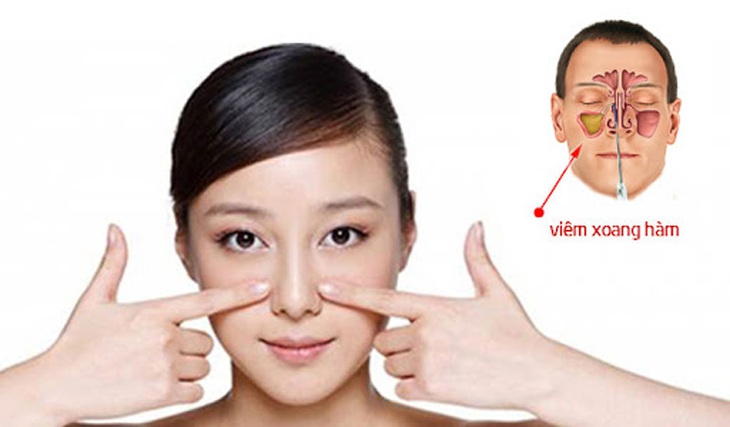 Viêm xoang hàm do răng có biểu hiện như thế nào? - Ảnh 2.