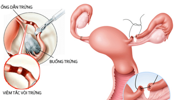 Nguyên nhân nào gây ra tình trạng hiếm muộn ở nữ giới? - Ảnh 2.