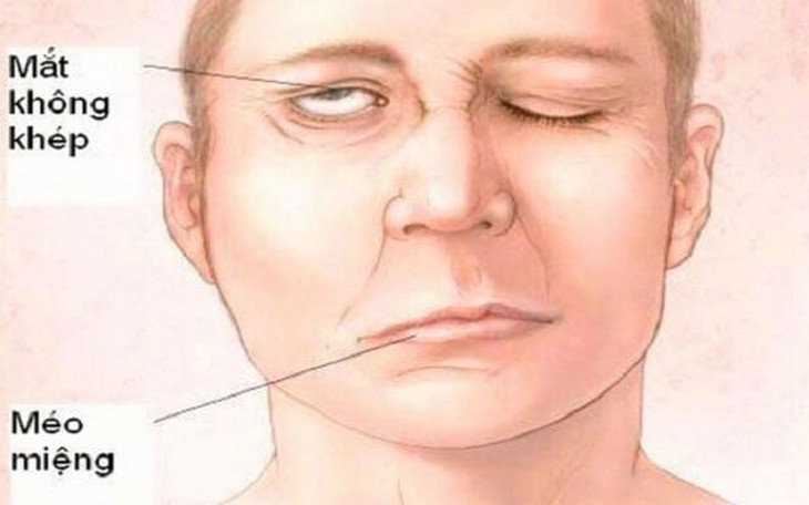 Tá hỏa vì liệt một bên mặt sau khi ngủ dậy