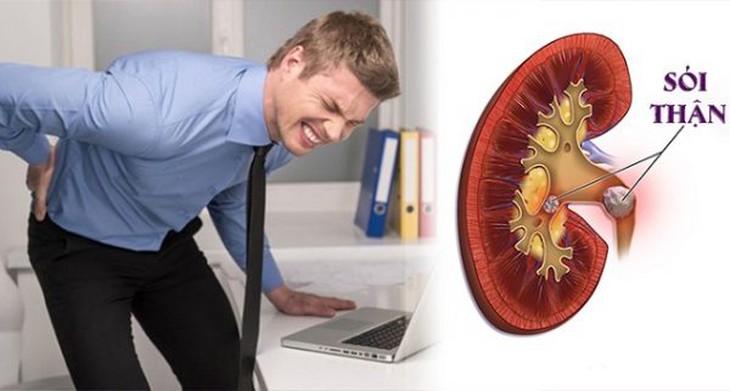 Sỏi thận tuy không phải bệnh hiểm nghèo nhưng sẽ gây rắc rối đến cuộc sống hằng ngày cũng như sức khỏe của bệnh nhân. Ảnh minh họa