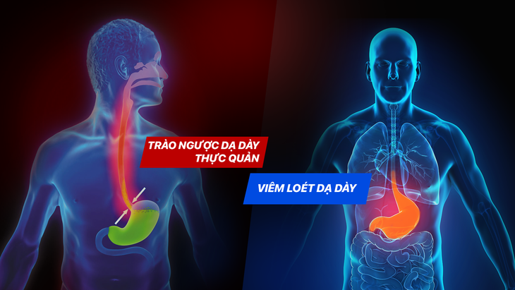 Lưu ý khi sử dụng thuốc dạ dày để chữa trào ngược - Ảnh 2.
