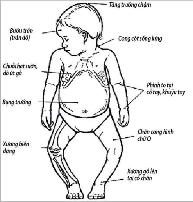 Còi xương: Nguyên nhân, dấu hiệu và cách chăm sóc - Ảnh 1. Còi xương: Nguyên nhân, dấu hiệu và cách chăm sóc - Ảnh 1.