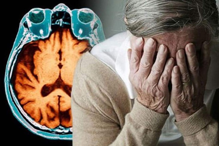 Cách ngăn ngừa bệnh Alzheimer tiến triển - Ảnh 2.