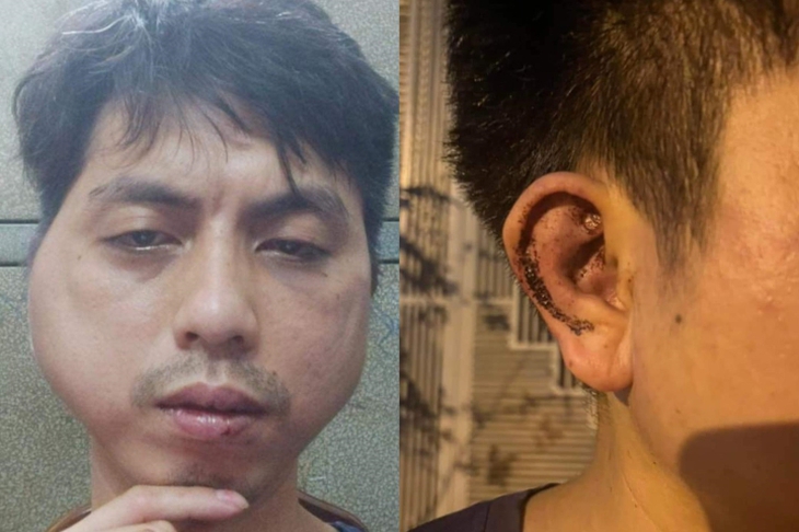 Khởi tố vụ án nhân viên quán lẩu bị đánh biến dạng khuôn mặt - Ảnh 2. Khởi tố vụ án nhân viên quán lẩu bị đánh biến dạng khuôn mặt - Ảnh 2.