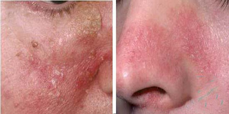 Bệnh viêm da tiết bã có tự hết không, chữa thế nào? - Ảnh 2. Bệnh viêm da tiết bã có tự hết không, chữa thế nào? - Ảnh 2.