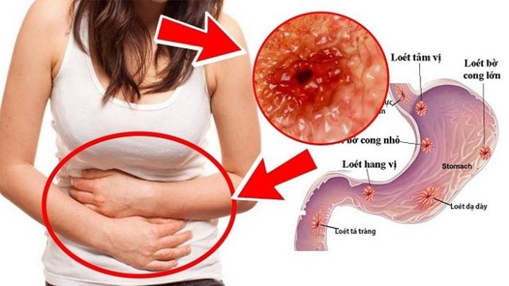 Giải pháp hỗ trợ viêm loét dạ dày tá tràng từ dược liệu cổ truyền‎ - Ảnh 1.