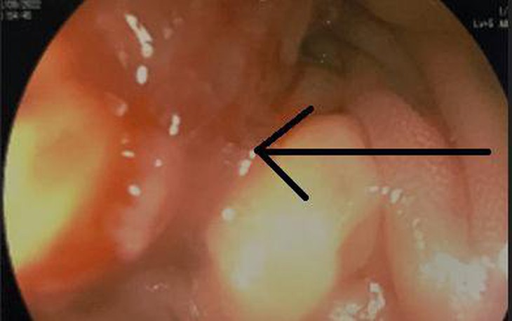 Bé trai 15 tuổi đã mắc ung thư đại tràng, làm gì để phòng tránh?