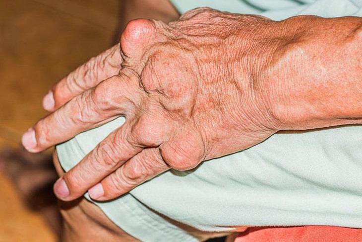 Hạt tophi ở người bệnh gout và những ảnh hưởng cần biết - Ảnh 2.