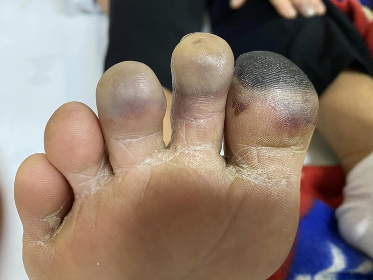 Khi lạnh cảnh giác với hội chứng Raynaud khiến ngón tay, chân xanh tím và đau buốt - Ảnh 1. Khi lạnh cảnh giác với hội chứng Raynaud khiến ngón tay, chân xanh tím và đau buốt - Ảnh 1.