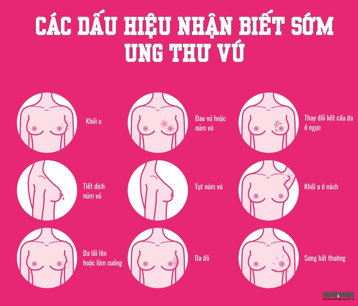 Ung thư vú: Các dấu hiệu nhận biết sớm - Ảnh 2.