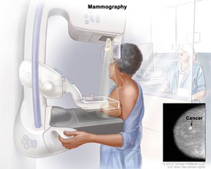 Chụp nhũ ảnh vú (Mammography). Bầu vú được ép vào 2 mặt phẳng, chiếu tia X liều thấp vào vùng vú để chụp ảnh mô vú.