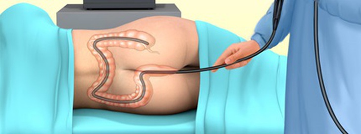 Nội soi đại tràng có thể phát hiện tổn thương tiền ung thư (polyp) và ung thư sớm.