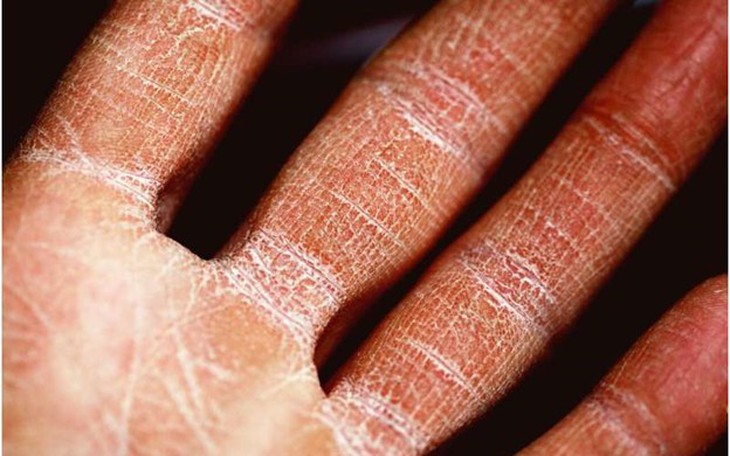 Liệu pháp mới điều trị bệnh viêm da dị ứng