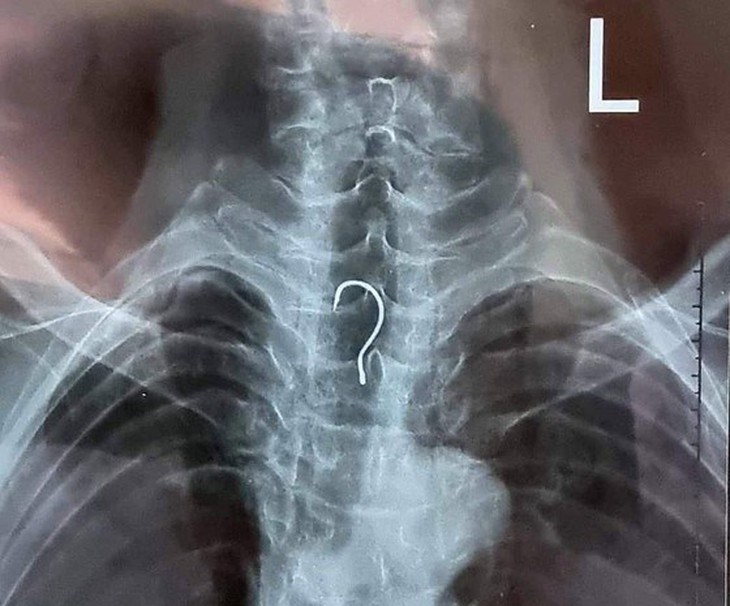 Gắp lưỡi câu mắc trong thực quản bệnh nhân - Ảnh 1.