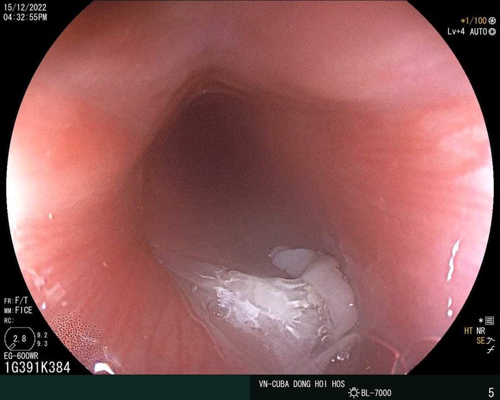 Xương cá chỉ vàng cắm sâu vào thực quản bệnh nhân - Ảnh 1.