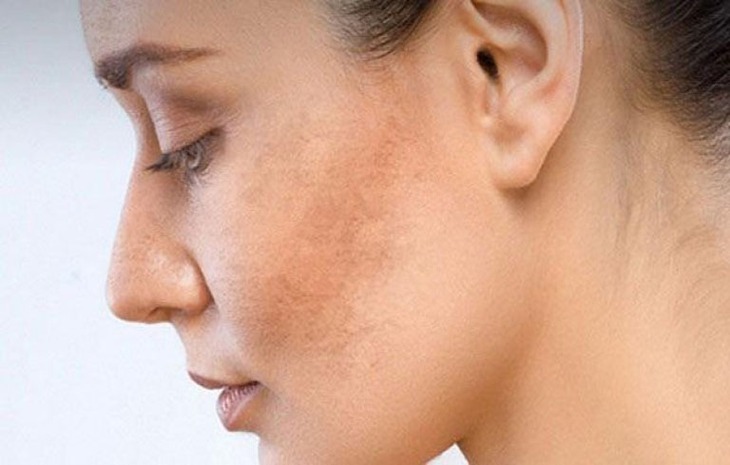 Điều trị sạm da sai khiến da sạm hơn và cách xử lý - Ảnh 1.