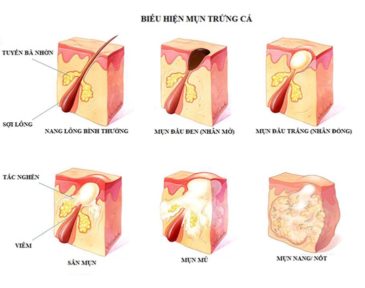Các loại mụn trứng cá và cách điều trị đúng - Ảnh 1. Các loại mụn trứng cá và cách điều trị đúng - Ảnh 1.