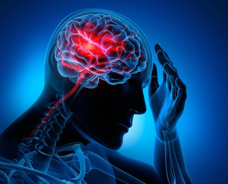 6 dấu hiệu đột quỵ cực nguy hiểm ai cũng phải biết  - Ảnh 2.