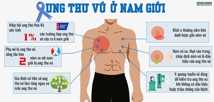 Ung thư vú nam: Nguyên nhân và triệu chứng lâm sàng - Ảnh 1.