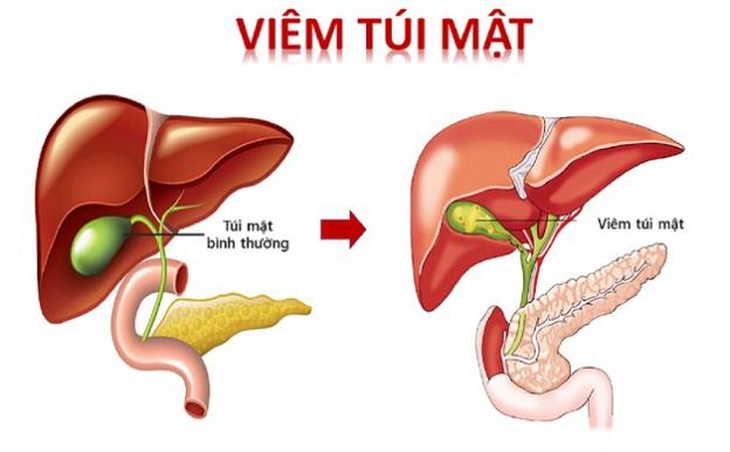6 huyệt vị hỗ trợ điều trị viêm túi mật - Ảnh 1.