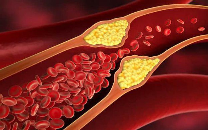 Giảm mỡ máu bằng chế độ ăn lành mạnh