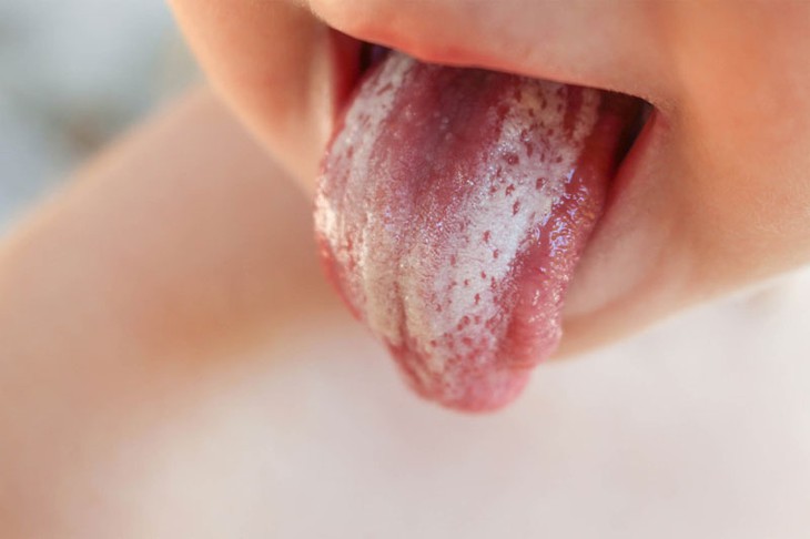 Tưa miệng ở trẻ em, chăm sóc và điều trị thế nào? - Ảnh 2.