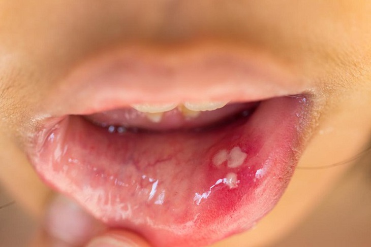 Nguy cơ mắc bệnh lây truyền qua đường tình dục khi quan hệ tình dục bằng miệng - Ảnh 4. Nguy cơ mắc bệnh lây truyền qua đường tình dục khi quan hệ tình dục bằng miệng - Ảnh 4.