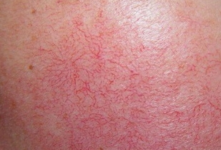 Cai và phục hồi da nhiễm corticoid do kem trộn - Ảnh 1.