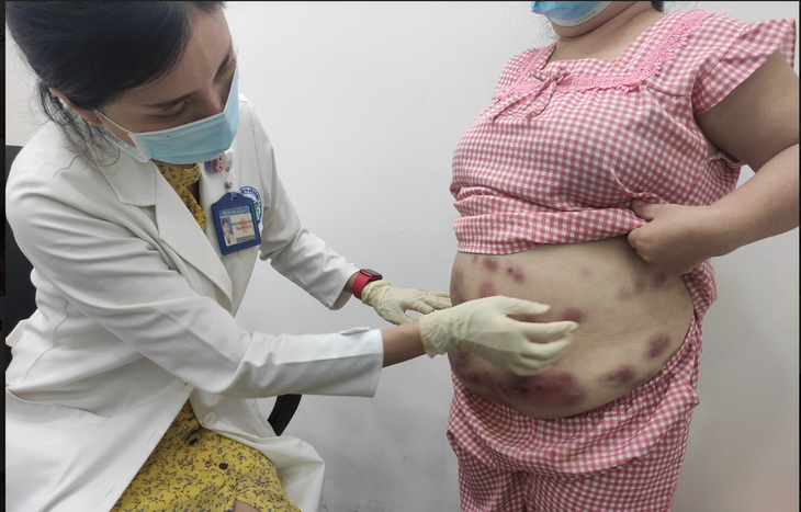 Tiêm tan mỡ bụng, người phụ nữ bị áp xe viêm, chảy mủ - Ảnh 1. Tiêm tan mỡ bụng, người phụ nữ bị áp xe viêm, chảy mủ - Ảnh 1.