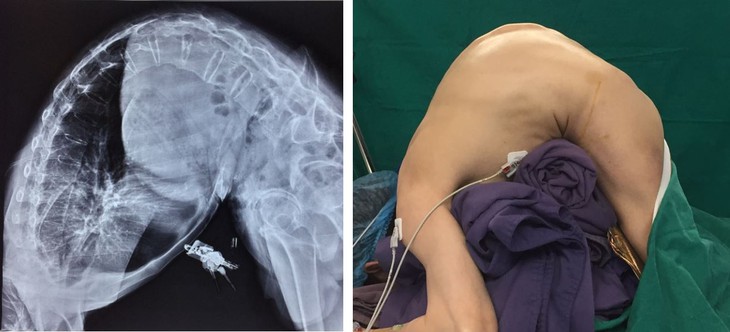 Điều trị vẹo cột sống vô căn tuổi thanh thiếu niên bằng phương pháp Lenke - Ảnh 1.