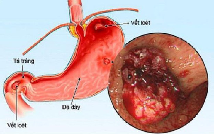 Bài thuốc dễ làm trị chứng đầy bụng, khó tiêu