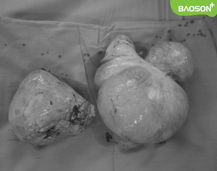 Chủ quan không điều trị, bệnh nhân U40 phải cắt tử cung bán phần vì khối u xơ 2,5kg - Ảnh 2. Chủ quan không điều trị, bệnh nhân U40 phải cắt tử cung bán phần vì khối u xơ 2,5kg - Ảnh 2.