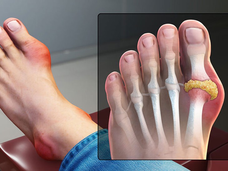 3 món ăn quen thuộc cần tránh khi đang có cơn đau gout cấp - Ảnh 2.