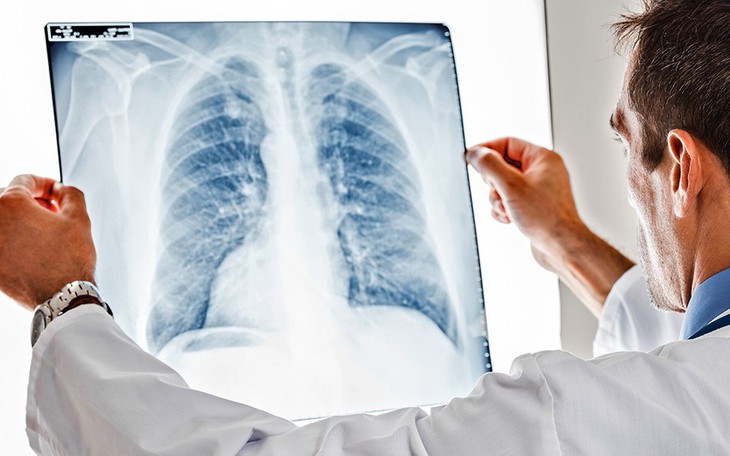 Các thuốc và phương pháp điều trị ung thư phổi