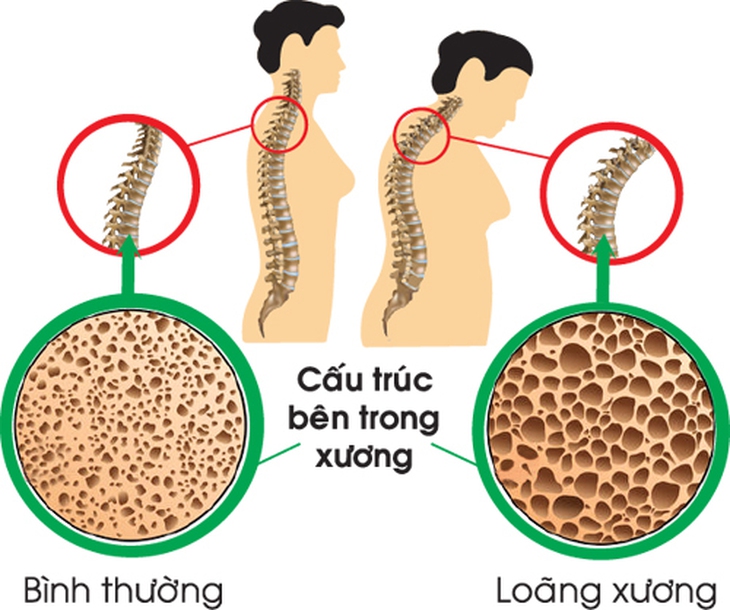 Phụ nữ mãn kinh nên ăn gì để phòng và giảm đau xương khớp khi trời lạnh? - Ảnh 2. Phụ nữ mãn kinh nên ăn gì để phòng và giảm đau xương khớp khi trời lạnh? - Ảnh 2.