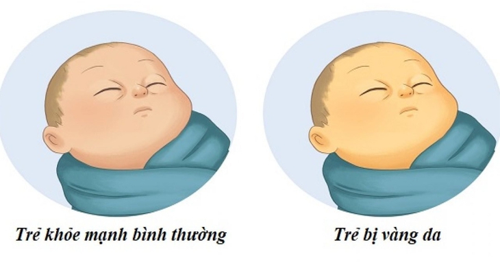 Cảnh giác với biểu hiện vàng da ở trẻ sơ sinh trong mùa đông - Ảnh 3.