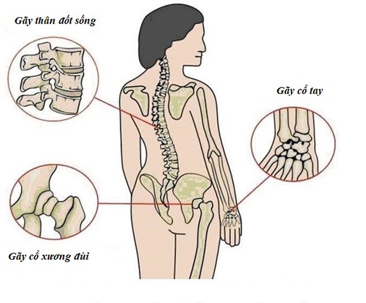 5 loại thực phẩm cần tránh khi bạn bị loãng xương - Ảnh 2. 5 loại thực phẩm cần tránh khi bạn bị loãng xương - Ảnh 2.