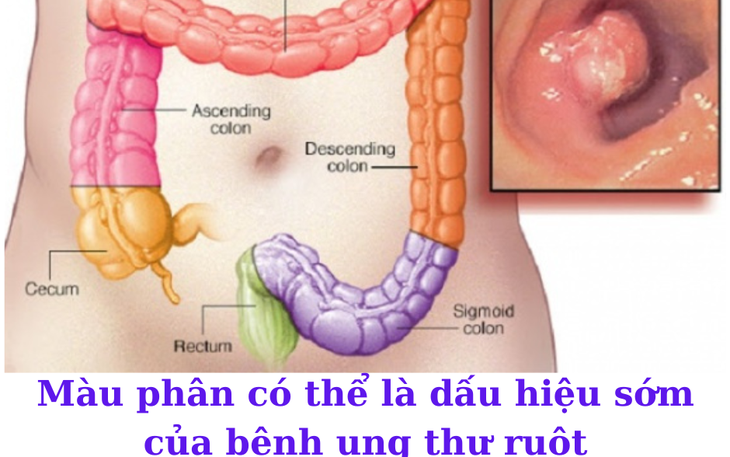 Thay đổi thói quen đi đại tiện có thể là dấu hiệu cảnh báo bệnh ung thư ruột