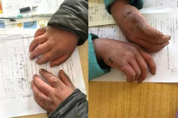 Cậu bé "người tuyết" từng làm hàng triệu trái tim thổn thức giờ ra sao sau 4 năm đầy biến động? - Ảnh 3.