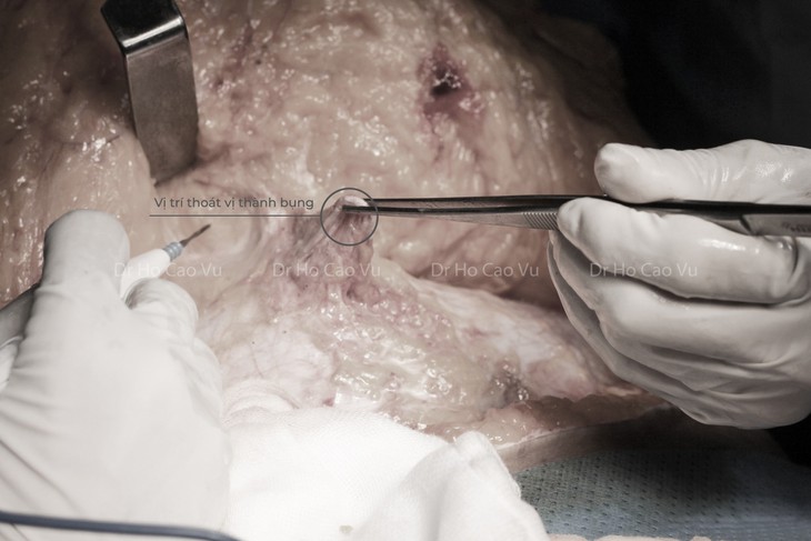 Bác sĩ chia sẻ kinh nghiệm tạo hình thành bụng cho bệnh nhân từng phẫu thuật đại tràng - Ảnh 2.