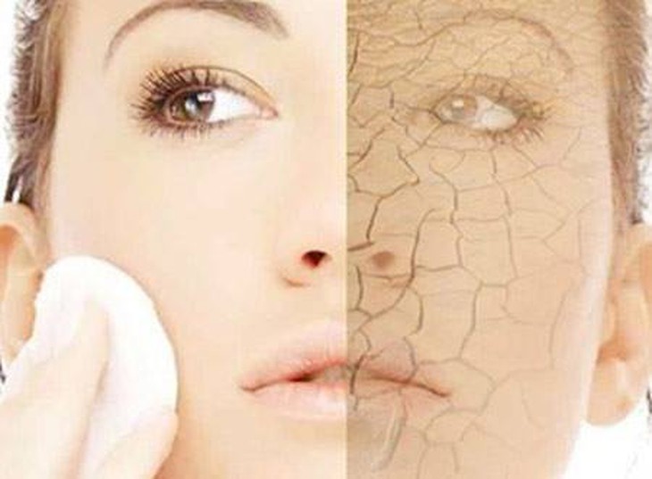 Da khô không gây ảnh hưởng đến sức khỏe nhưng sẽ gây những ảnh hưởng đến sinh hoạt hàng ngày của bạn. Ảnh minh họa