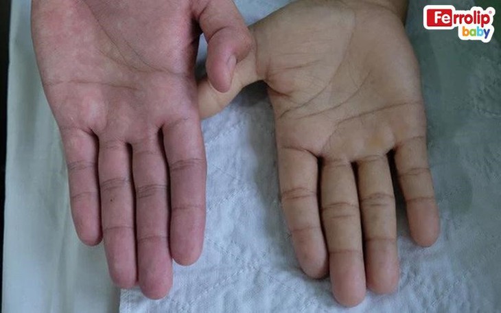 Có nên bổ sung sắt cho trẻ dưới 1 tuổi? - Ảnh 2.