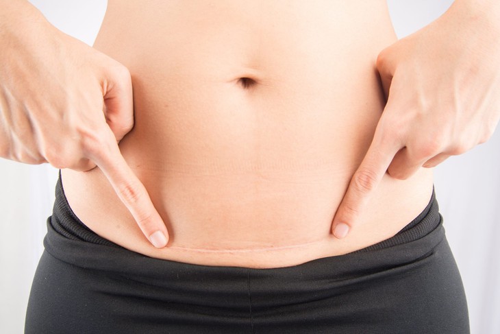 Mổ nội soi can thiệp điều trị vô sinh do khuyết sẹo mổ lấy thai - Ảnh 3.