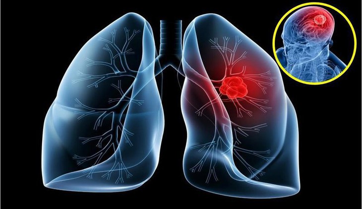 Ung thư phổi di căn não khiến nghệ sĩ Tiến Hợi “gục ngã” có phòng được không? - Ảnh 2. Ung thư phổi di căn não khiến nghệ sĩ Tiến Hợi “gục ngã” có phòng được không? - Ảnh 2.
