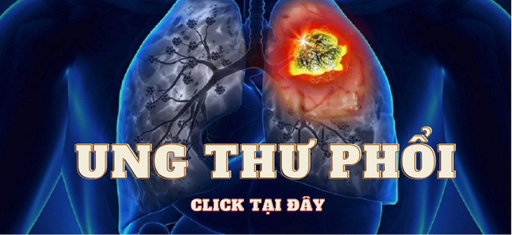 Ung thư phổi di căn não - căn bệnh khiến nghệ sĩ Tiến Hợi 'ra đi' có phòng được không? - Ảnh 5. Ung thư phổi di căn não - căn bệnh khiến nghệ sĩ Tiến Hợi 'ra đi' có phòng được không? - Ảnh 5.