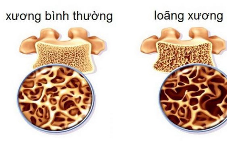 Dừng uống thuốc bảo vệ xương, có thể làm tăng nguy cơ gãy xương