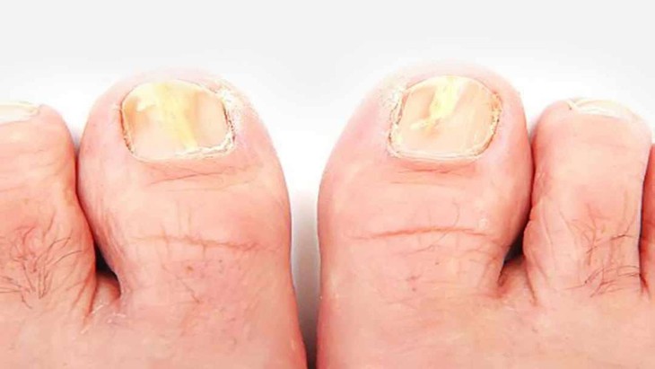 Để có thể phòng ngừa bệnh nấm móng tái phát cần có lời tư vấn từ bác sĩ chuyên khoa. Ảnh minh họa