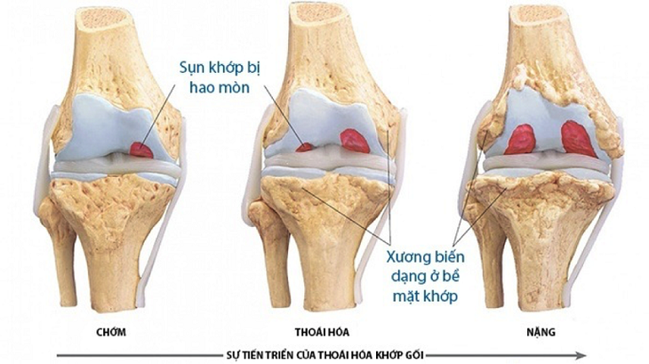 7 lý do khiến khớp gối bị thoái hóa- Ảnh 1. 7 lý do khiến khớp gối bị thoái hóa- Ảnh 1.